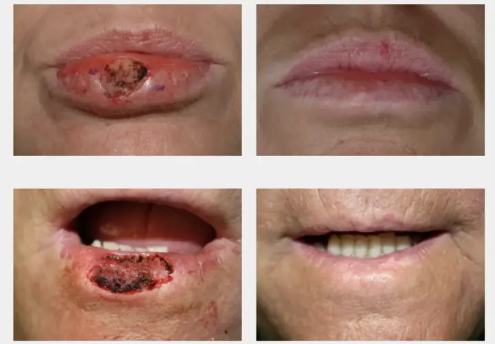 Cuatro imágenes muestran la evolución de un bulto en el labio, desde una lesión hasta la curación.