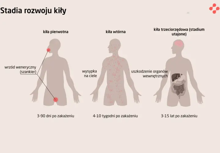Ilustracja przedstawia stadia rozwoju kiły: pierwotna (wrzód), wtórna (wysypka) i trzeciorzędowa (uszkodzenie organów).