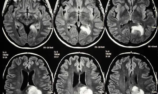 Czy rezonans magnetyczny wykryje chorobę psychiczną? Oto prawda