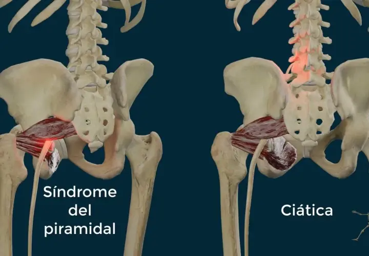 Músculos piramidales: diferencias clave entre piriforme y piramidal