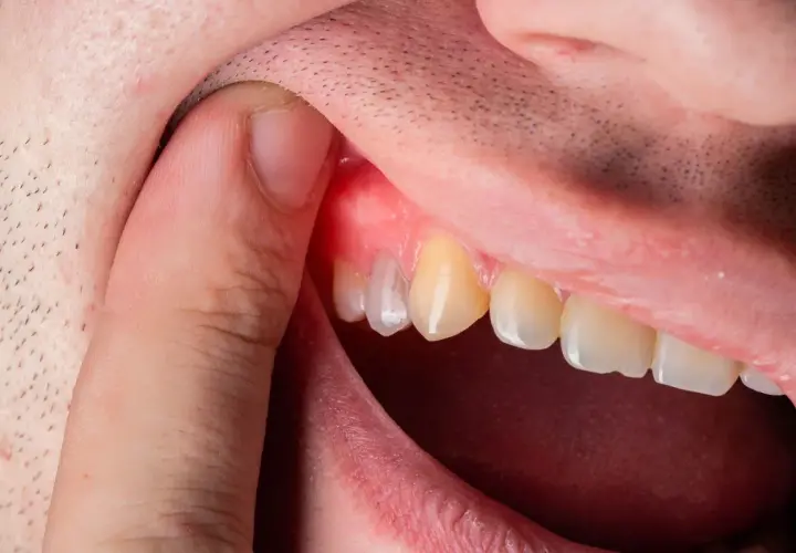 Gengiva arrossata e gonfia vicino a un dente, sintomo di un ascesso dentale. Quanto dura? Dipende dalla cura.