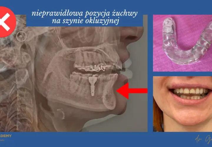 Rentgen żuchwy z nieprawidłową pozycją na szynie zgryzowej. Widoczna szyna i uśmiech pacjentki.