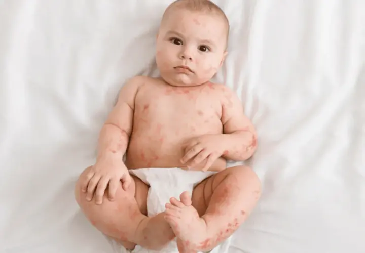 Bambino con eruzione cutanea rossa su tutto il corpo, possibile sudamina bambini.