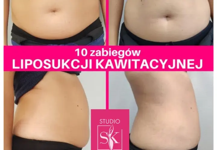Ile zabiegów liposukcji kawitacyjnej? Odkryj swój plan!