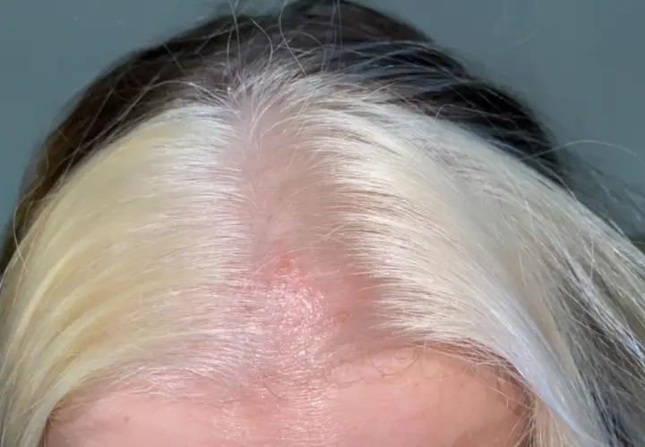 Cuero cabelludo enrojecido y con irritación, con mechones de cabello oscuro y rubio. Busca cómo curar quemaduras en el cuero cabelludo por decoloración.