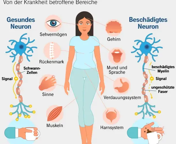 Plötzlich multiple Sklerose: Die häufigsten Symptome und Beschwerden