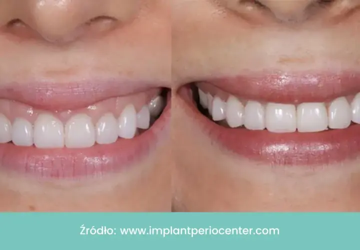Uśmiech przed i po zabiegu redukcji uśmiechu dziąsłowego. Botoks skutecznie maskuje gummy smile.