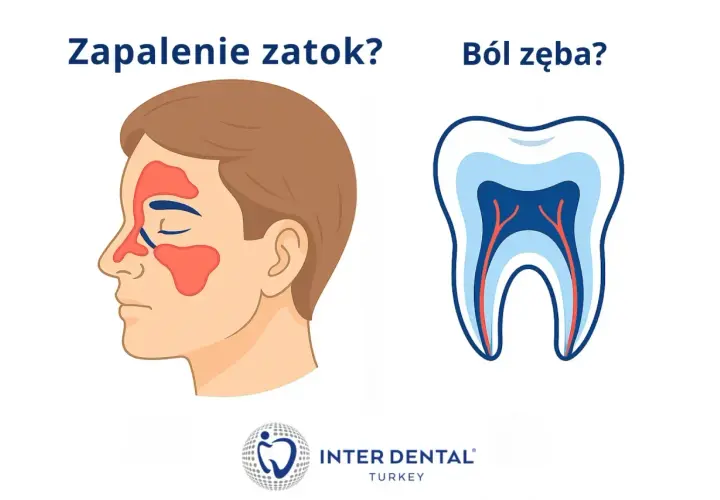 Zapalenie zatok czy ból zęba? Ilustracja przedstawia profil twarzy z zaznaczonymi zatokami oraz przekrój zęba z widocznymi nerwami.