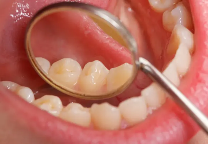 Widok jamy ustnej z lusterkiem dentystycznym. Na zębach widoczne są żółtawe przebarwienia, które mogą być początkiem próchnicy lub osadu.