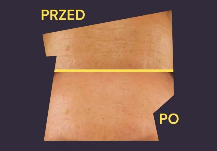 Przed i po: skóra z widocznymi zmarszczkami i przebarwieniami staje się gładsza i jaśniejsza. Kolagen na co pomaga? Wygładza i poprawia wygląd skóry.