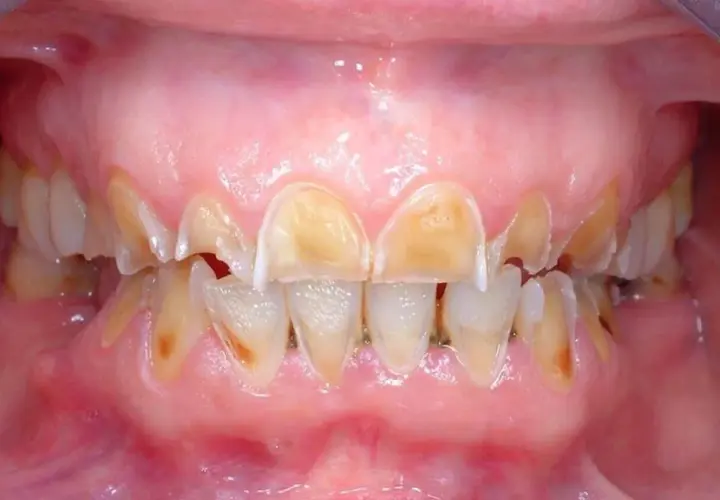 Denti ingialliti e consumati, con smalto eroso, un segno visibile degli effetti dell'anoressia sulla salute orale.