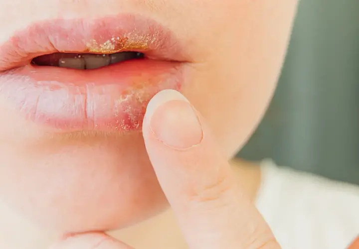 Labios con herpes labial, mostrando costras amarillentas y enrojecimiento. Un dedo se acerca a la zona afectada.