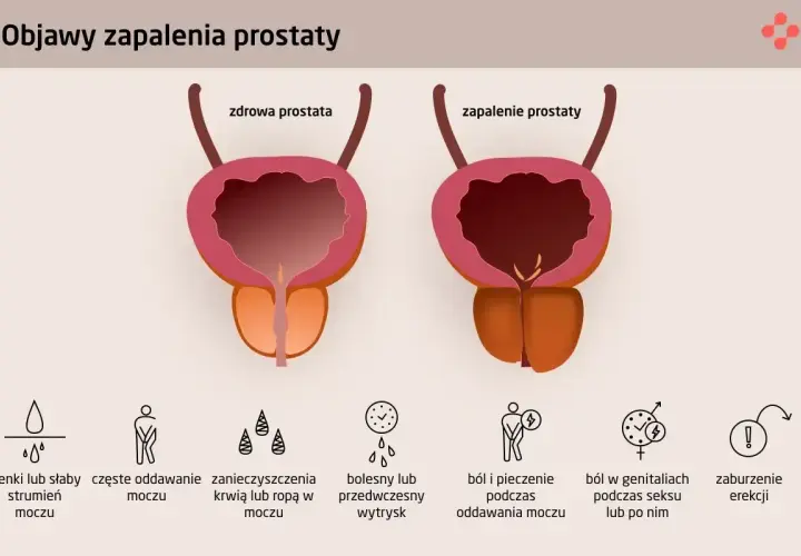Porównanie zdrowej prostaty i zapalenia prostaty, z objawami takimi jak ból, problemy z oddawaniem moczu i zaburzenia erekcji.
