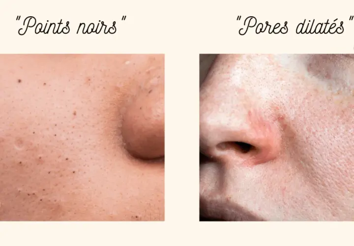 Comparaison de peau : points noirs et pores dilatés. Apprenez comment resserrer les pores pour une peau plus lisse.