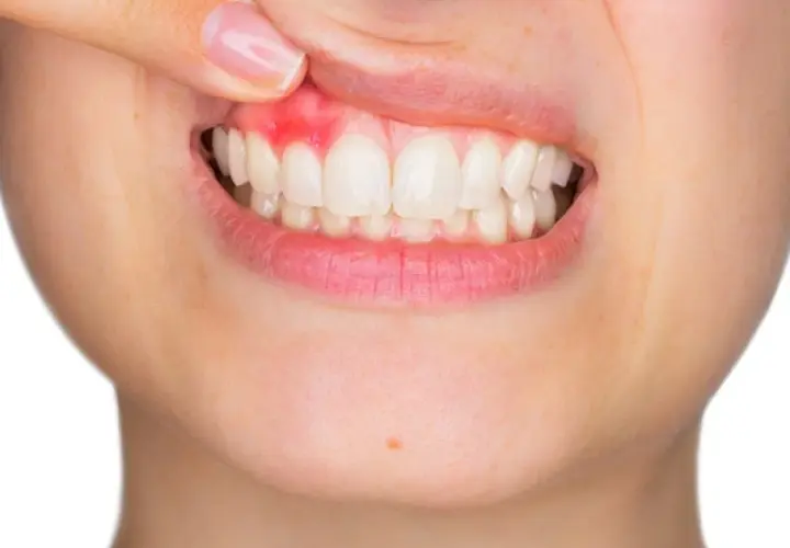 Encía inflamada y enrojecida, señal de periodontitis severa.