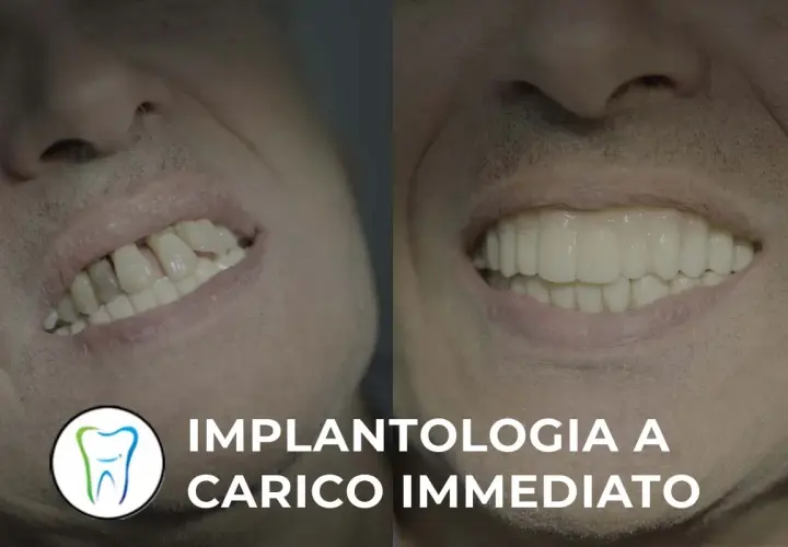 Prima e dopo: sorriso trasformato con implantologia a carico immediato. Valuta le controindicazioni per un risultato perfetto.