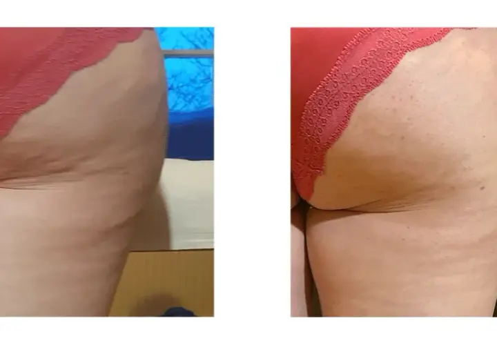 Endermologia: Redukcja cellulitu i modelowanie sylwetki czy to dla Ciebie?
