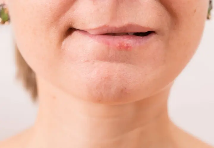 Labios con herpes, posiblemente por exposición al sol.