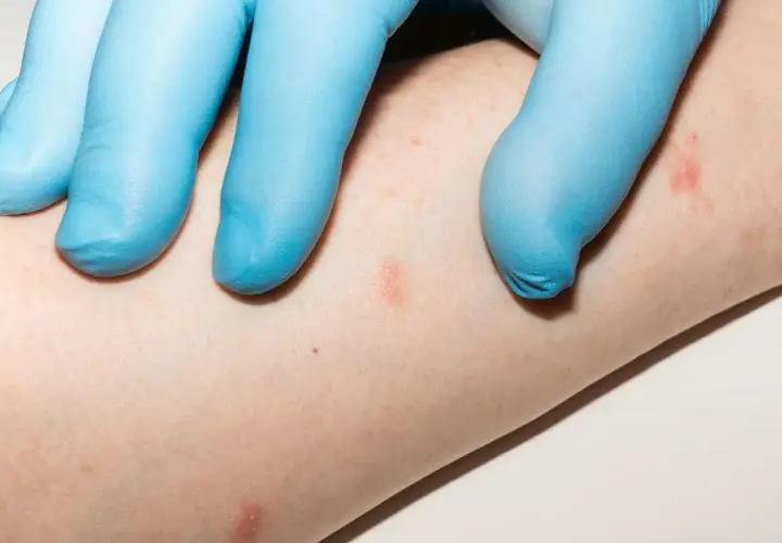 Mano con guanto blu esamina piccole lesioni cutanee rosse su un braccio, indicative di psoriasi guttata nei bambini.