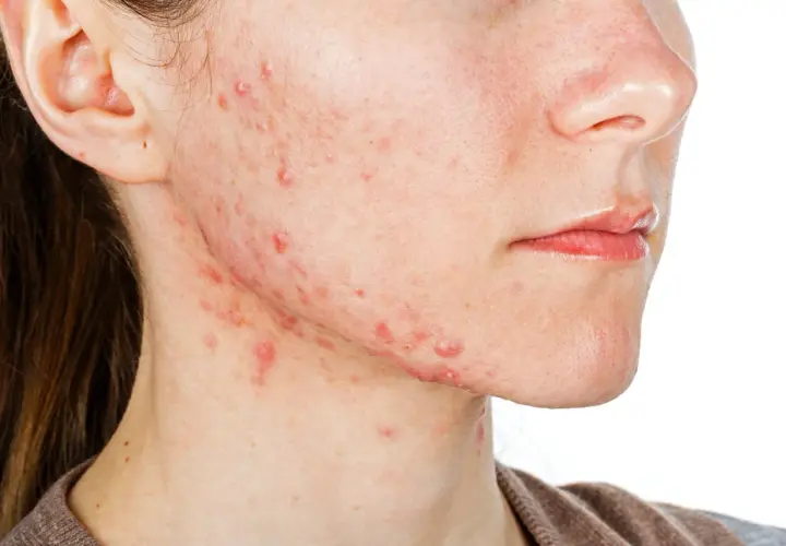 Visage avec acné légère sur la joue et le cou, une peau qui pourrait bénéficier de Roaccutane.