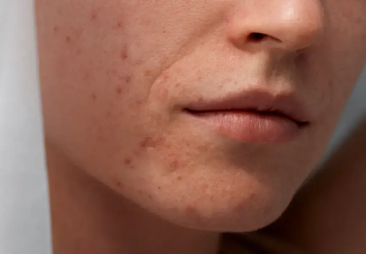 Gros plan sur le visage d'une femme montrant des imperfections et des rougeurs, typiques de l'acné de fin de grossesse.