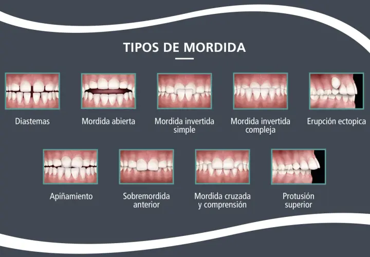 Ilustración de varios tipos de mordida dental, incluyendo una **mordida abierta** donde los dientes frontales no se tocan al cerrar la boca.