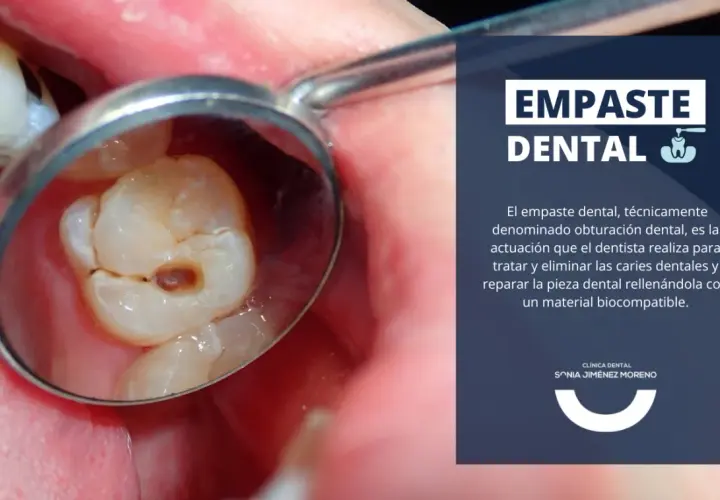 Reflejo en espejo dental de una muela con empaste, mostrando la cavidad tratada.