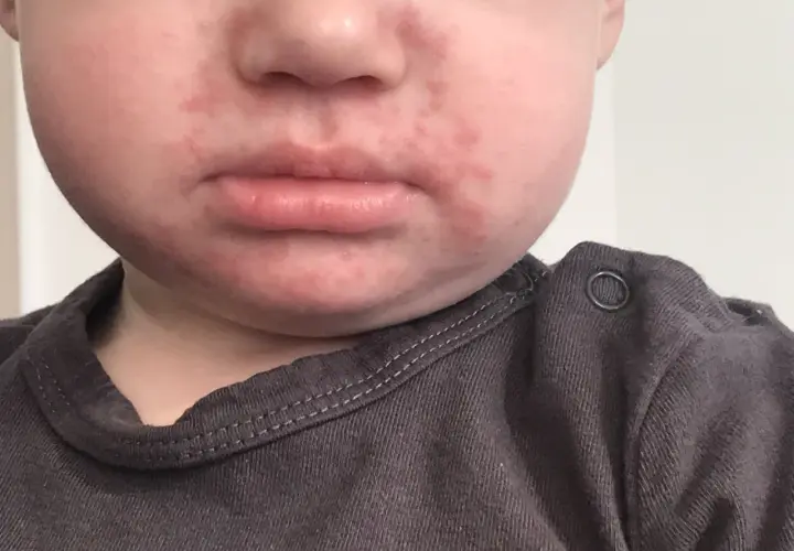 Czerwone krostki od sliny u dziecka wokół ust, widoczne na policzkach i brodzie.