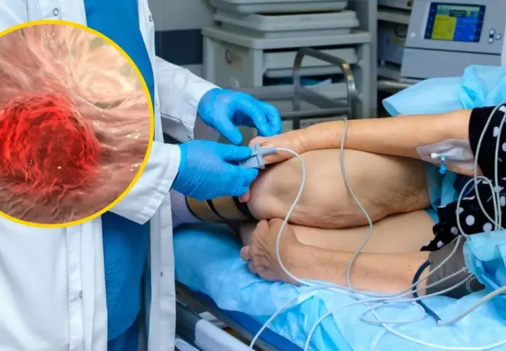 Lekarz w rękawiczkach przygotowuje pacjenta do zabiegu, podczas gdy powiększony obraz pokazuje komórki raka jelita grubego.