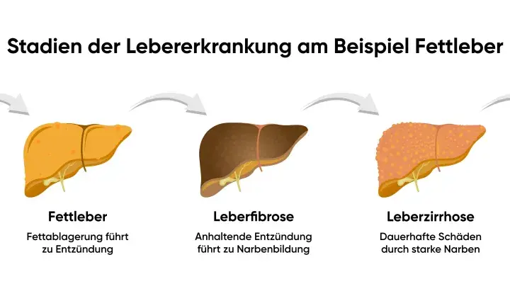 Stadien der Lebererkrankung: gesunde Leber, Fettleber (Fettablagerung führt zu Entzündung), Leberfibrose, Leberzirrhose und Leberkrebs. Was tun bei Fettleber?