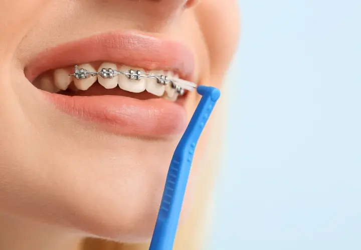Pulizia dei denti con apparecchio, un passo fondamentale per prevenire l'alitosi. Rimedi efficaci per un sorriso smagliante.