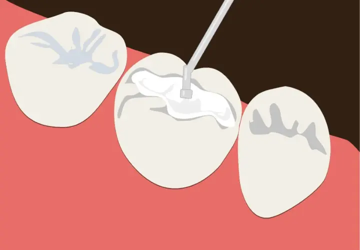 Aplicación de sellador dental para proteger contra caries y aliviar los dientes sensibles.