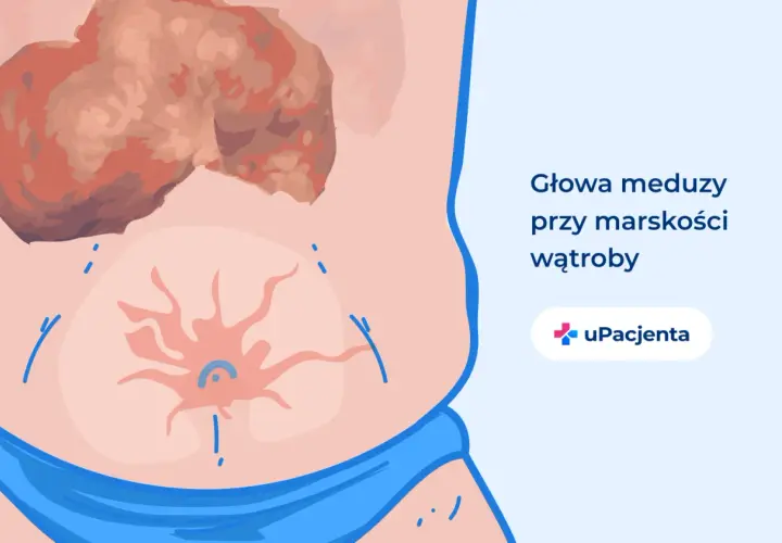 Ilustracja przedstawia objawy marskości wątroby, takie jak "głowa meduzy" na brzuchu. Dzięki leczeniu, wyleczyłem marskość wątroby.