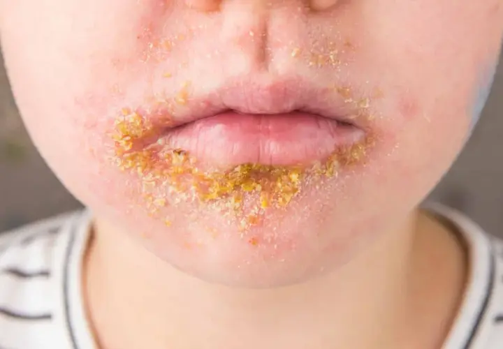 Bouche d'enfant atteinte d'impétigo, une infection cutanée qui peut causer du stress et de l'inconfort.