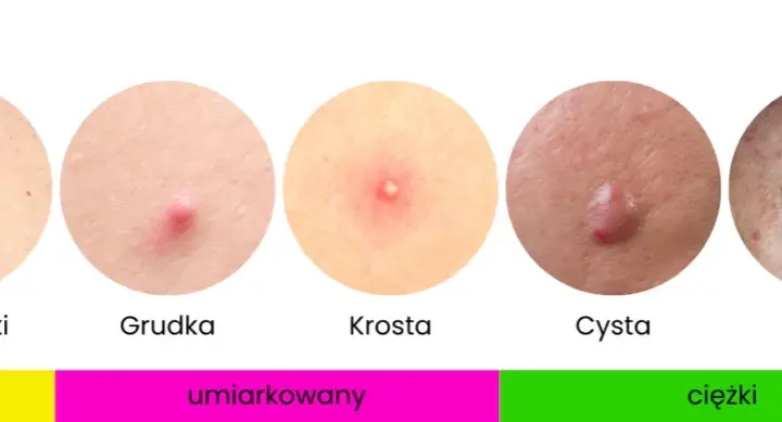 Jak pozbyć się pryszczy? Kompleksowy przewodnik po leczeniu