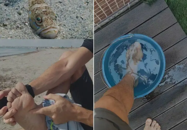Pez escorpión picadura: pie en agua caliente tras sufrir una picadura en la playa.