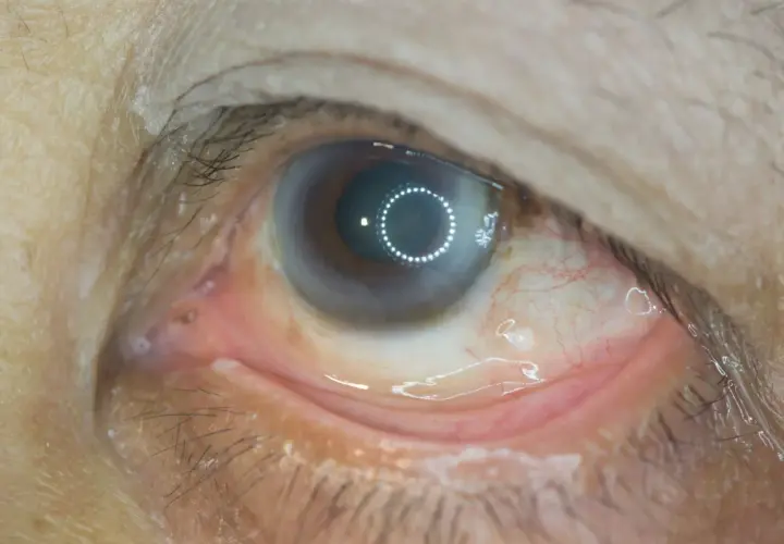 Oko z widocznymi zmianami, mogącymi wskazywać na retinopatię cukrzycową. Widoczne zaczerwienienie spojówki i drobne wybroczyny.