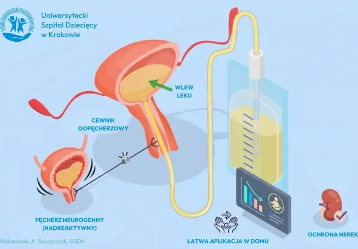 Ilustracja przedstawia pęcherz neurogenny, cewnik dopęcherzowy i system do wlewu leku, wskazując na ochronę nerek i łatwą aplikację w domu.