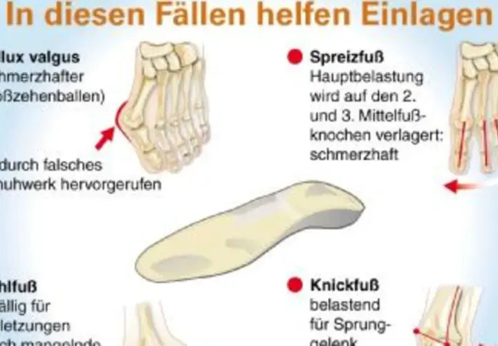 Weichpolstereinlagen helfen bei Hallux valgus, Spreizfuß, Hohlfuß und Knickfuß. Sie entlasten schmerzhafte Bereiche und beugen Verletzungen vor.