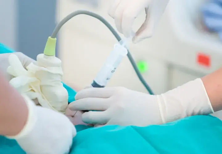 Mani guantate eseguono amniocentesi, un esame diagnostico che si fa solitamente tra la 15ª e la 20ª settimana di gravidanza.