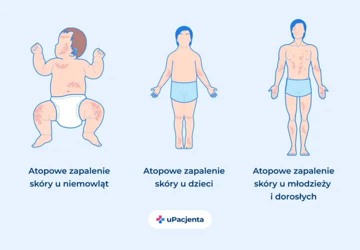 Atopowe zapalenie skóry (AZS) to choroba skóry widoczna u niemowląt, dzieci i dorosłych, objawiająca się zmianami skórnymi.