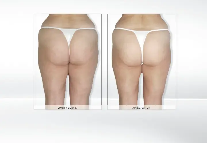 Endermologia: Kiedy efekty i jak utrzymać je na dłużej?
