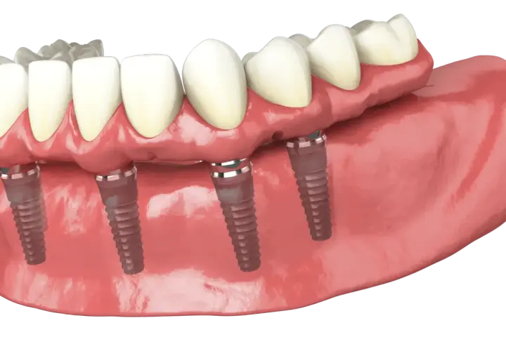 Dettaglio di una protesi dentale fissa su impianti, simile alla protesi Toronto, con denti bianchi e gengive rosa.