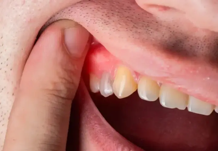 Ropa w dziąśle: Co robić? Szybka ulga i kiedy do dentysty