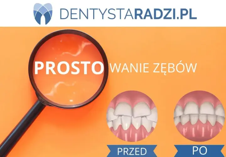 Proste wyrównanie zębów dzięki aparatowi ortodontycznemu. Przed i po leczeniu.