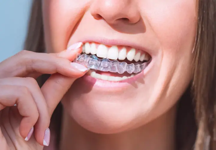 Mujer se coloca un alineador transparente. Para mantenerlos impecables y evitar que el Invisalign amarillo, es clave una buena higiene.