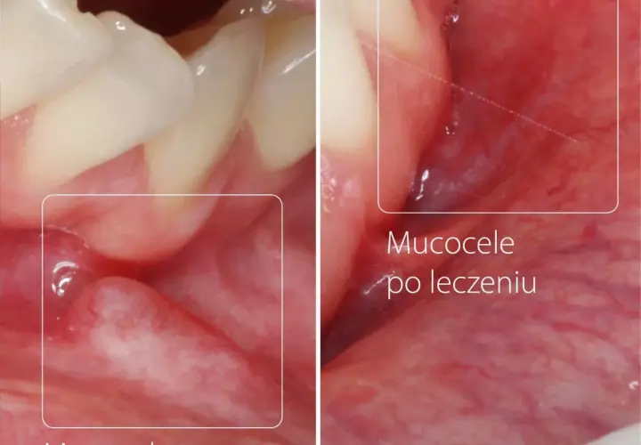 Przed i po leczeniu torbieli w jamie ustnej. Widoczne zmiany na błonie śluzowej.