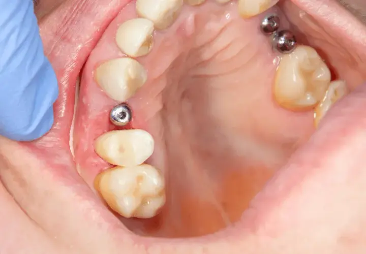 Implant zęba: Poznaj fakty! Zabieg, zalety, cena Twój nowy uśmiech