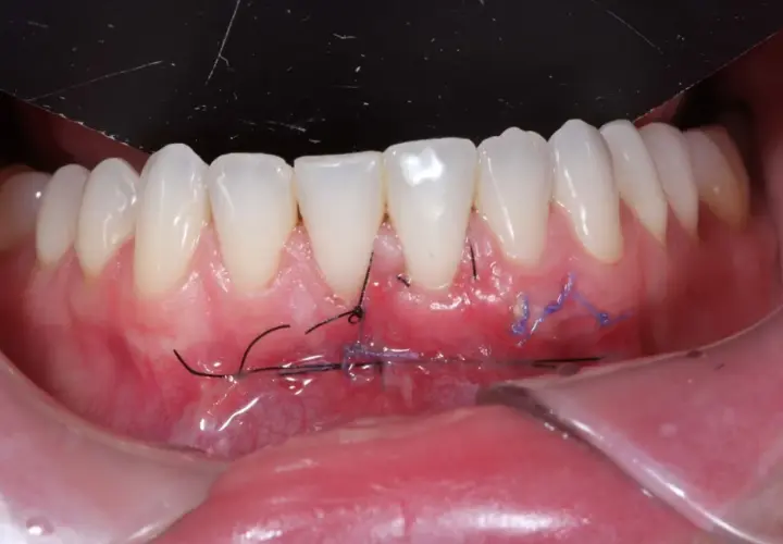 Boca con injerto libre de encía y suturas visibles. El tejido gingival se ve enrojecido y con puntos de sutura negros y morados.