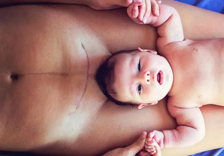 Ein Baby liegt auf dem Bauch seiner Mutter, deren Kaiserschnittnarbe sichtbar ist. Mögliche Symptome eines Geburtstraumas nach Kaiserschnitt können hier thematisiert werden.